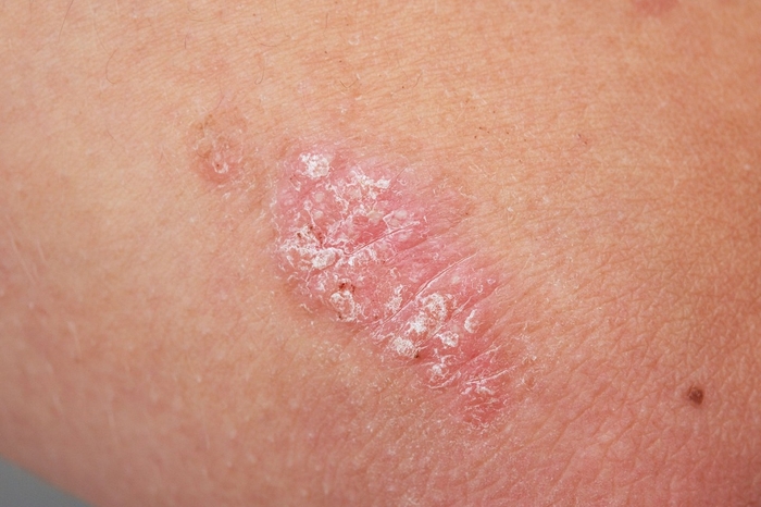 PUVA en NB-UVB blijven een effectieve behandeling tegen psoriatica; Onderzoek mei 2021
