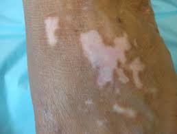 NB-UVB-therapie is effectief bij het verlichten van psychologische stress en het verbeteren van de kwaliteit van leven van patiënten met vitiligo.