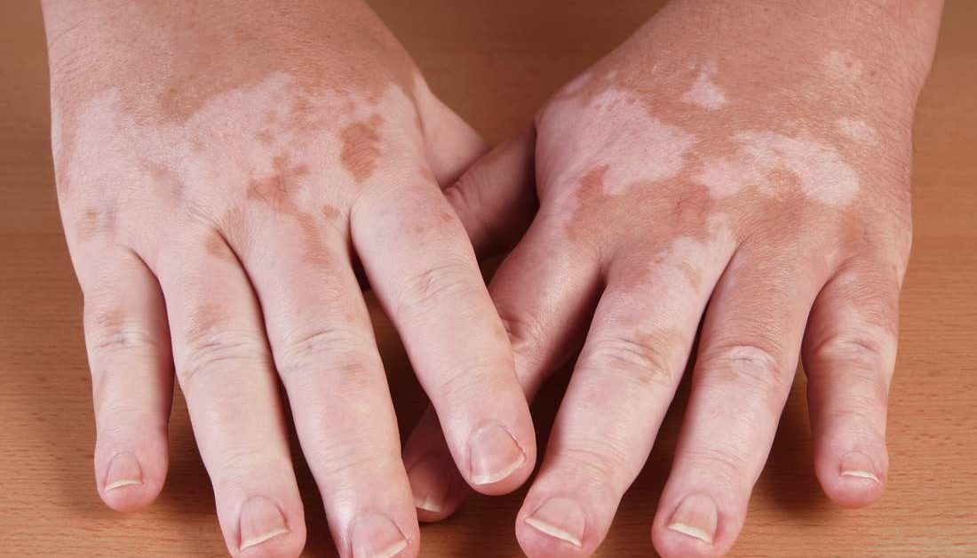De bevindingen van deze systematische review en meta-analyse suggereren dat UV-fototherapie een veilige behandeling is voor vitiligo zonder significant risico op huidkanker.